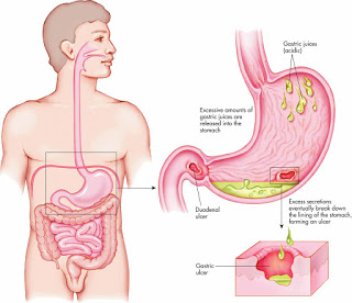 Illustration for article titled Obat Maag Alami Cepat